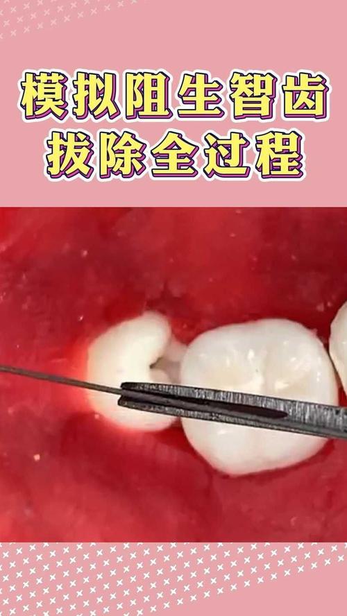智齿拔除种牙-图2