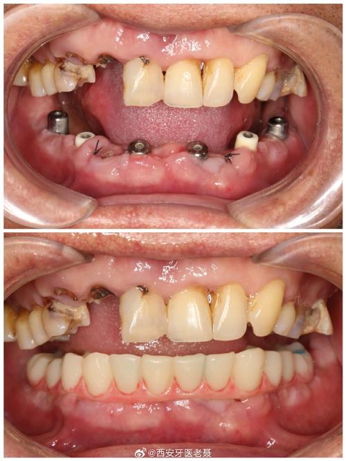 种植牙种太深-图2