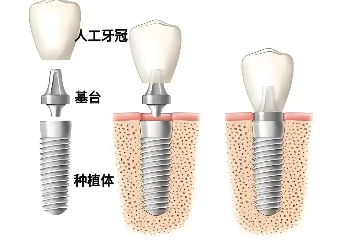 种牙最好技术-图1