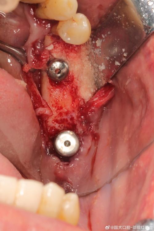 后牙即刻种牙-图1 后牙即刻种牙-图1