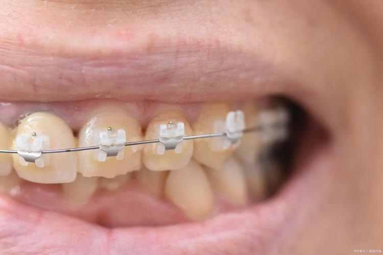 rw目标引导性正畸-图3