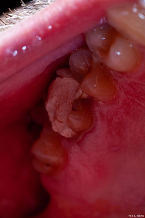正畸过程中牙齿流血-图1