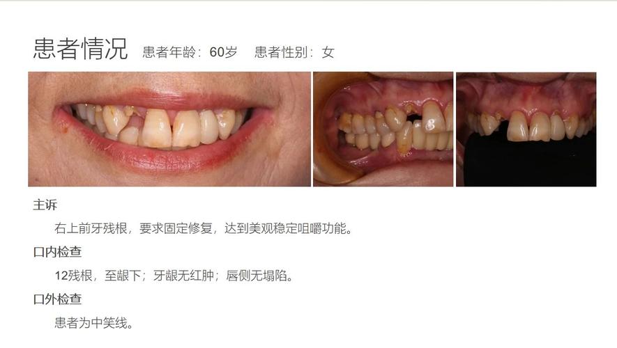 种牙失败经历-图1