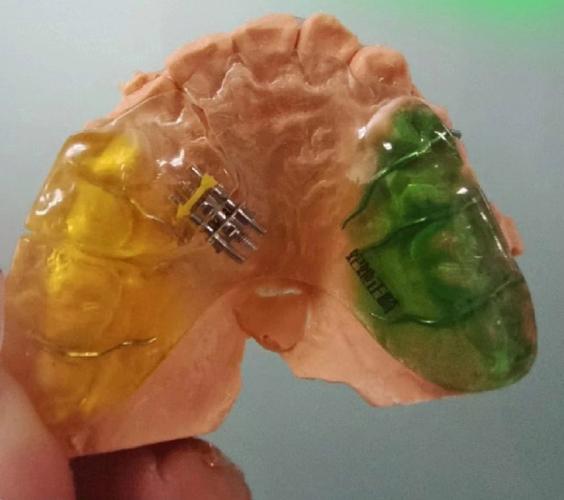 正畸螺旋扩弓器图片-图3