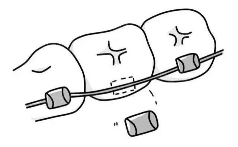 正畸烤瓷牙托槽掉了-图3