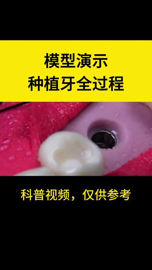 种牙手术模拟-图1