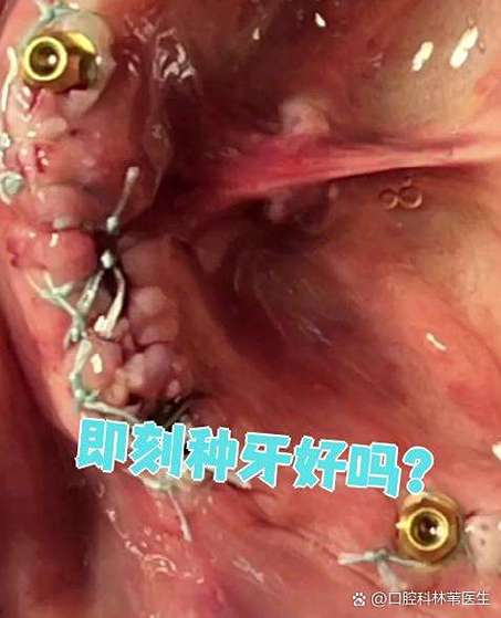 天津即刻种牙-图3