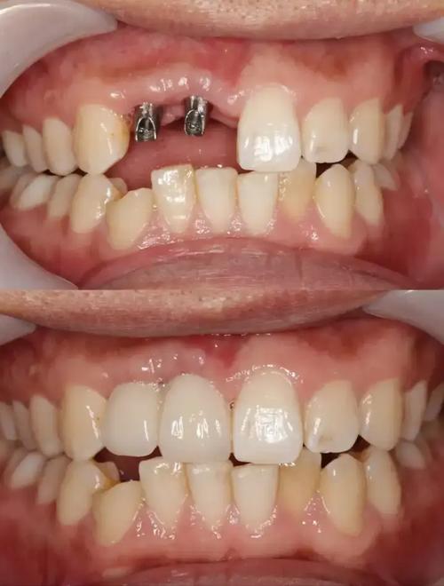 种牙vs活动义齿，哪种更适合缺牙修复？-图1