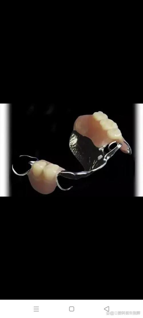 种牙vs活动义齿，哪种更适合缺牙修复？-图2