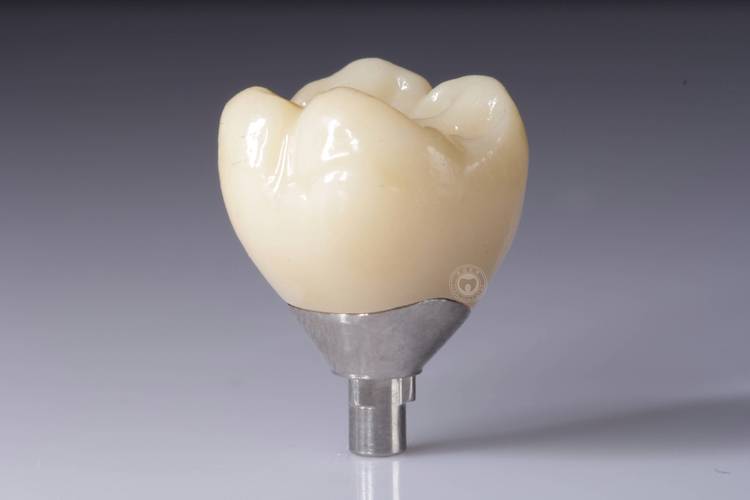 种牙vs活动义齿，哪种更适合缺牙修复？-图3