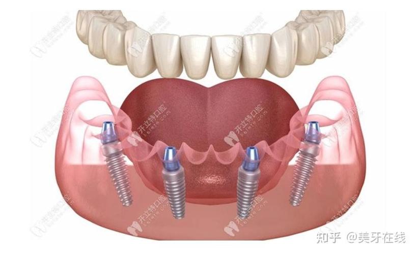 苏州无锡种牙-图1