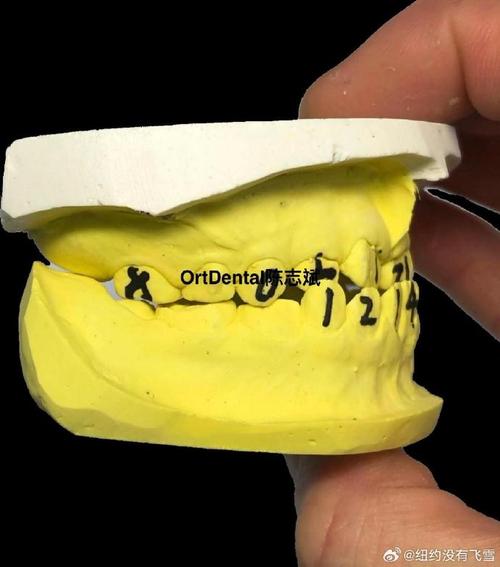 正畸FR是什么意思-图2 正畸FR是什么意思-图2