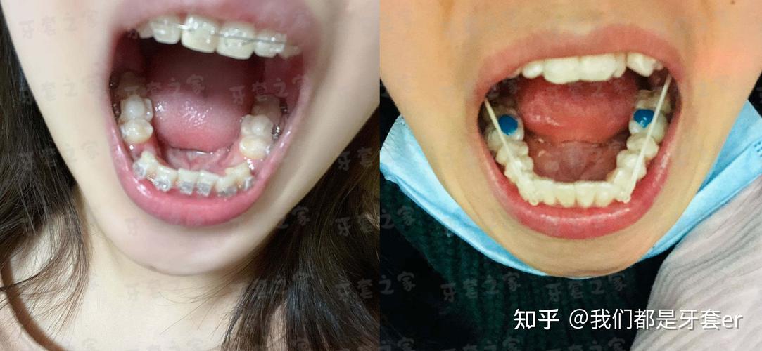 正畸牙弄的白色垫高-图1