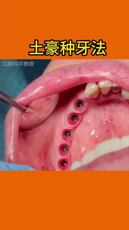 下牙下压种牙-图3