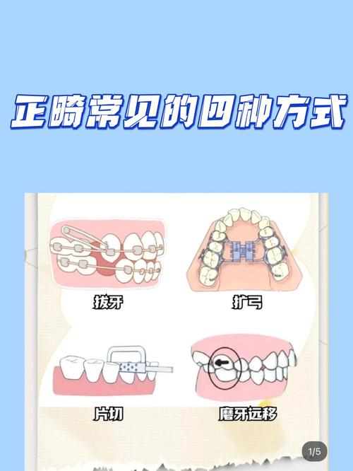 正畸牙齿顺时针矫正-图3