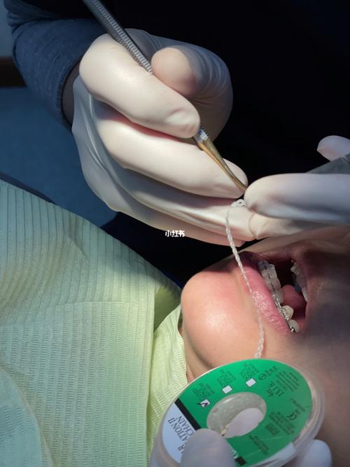 正畸牙齿上橡皮链痛-图3