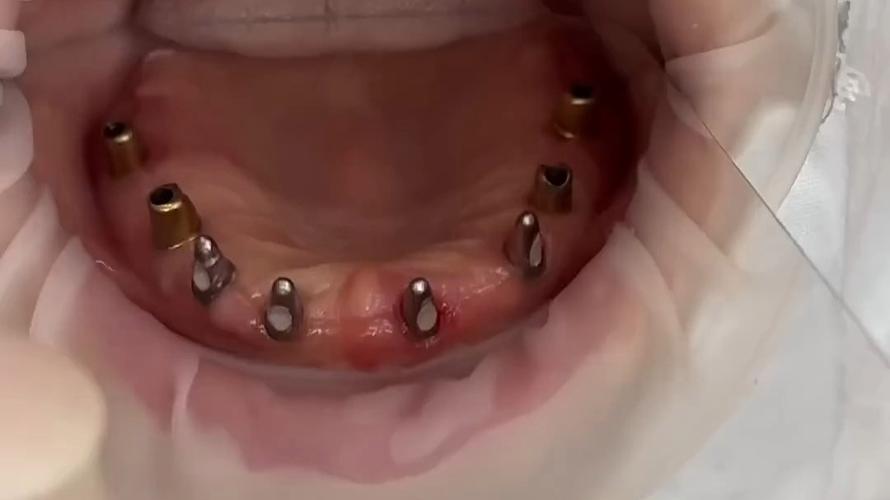 全口牙 种牙-图1