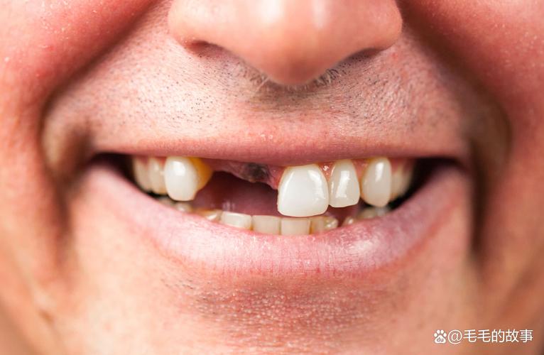 种牙后为何仍缺牙？原因解析与应对指南-图1