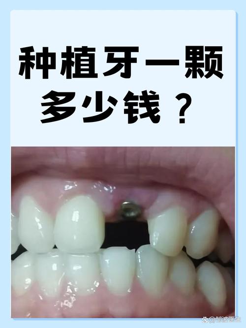 没钱种牙植牙-图2