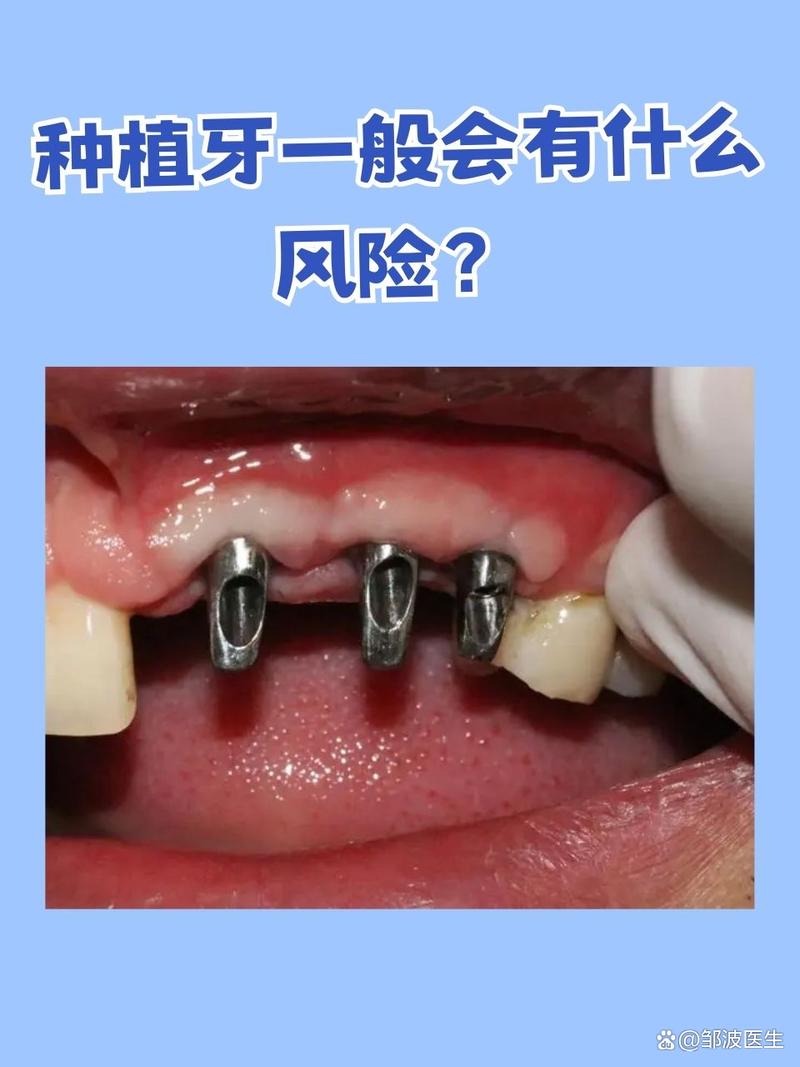 种牙为何用自己牙?自体牙移植的优势何在?-图1 种牙为何用自己牙?自体牙移植的优势何在?-图1
