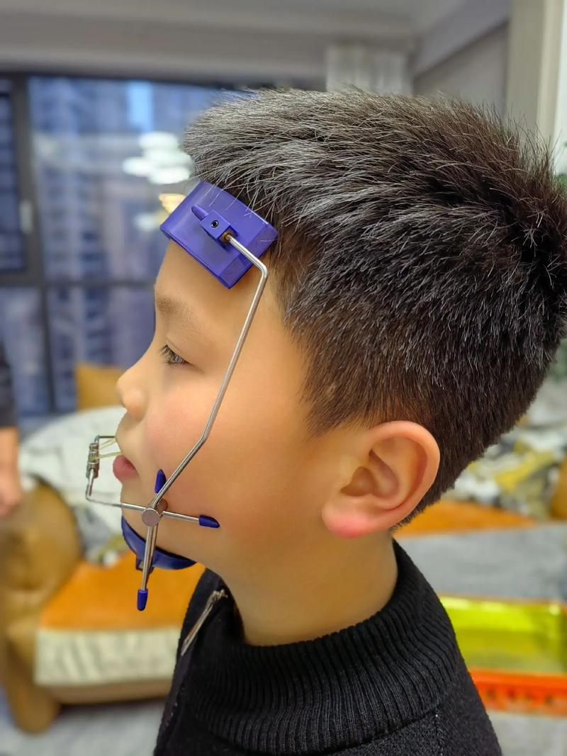正畸后儿童保持器到底要戴多久？-图3