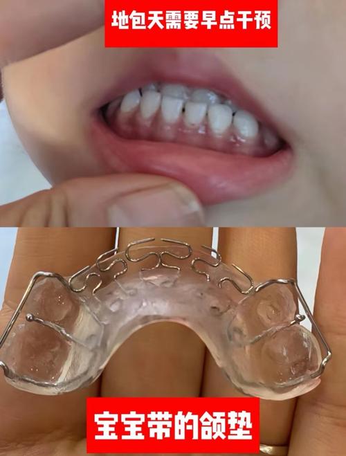 正畸后儿童保持器到底要戴多久？-图2