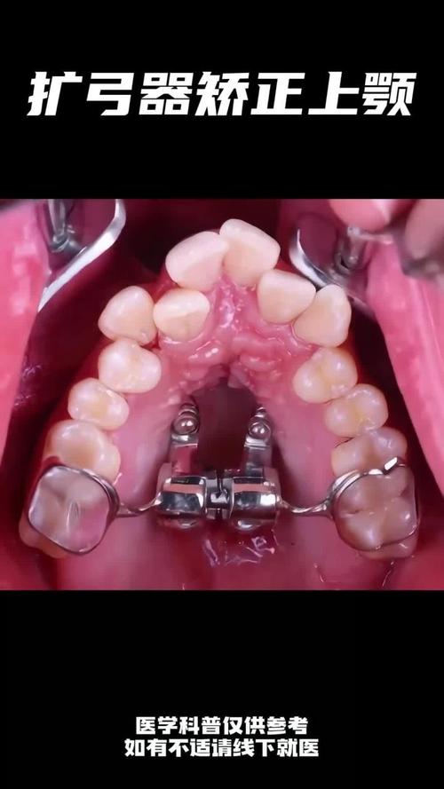 只拔出上合牙齿正畸-图3