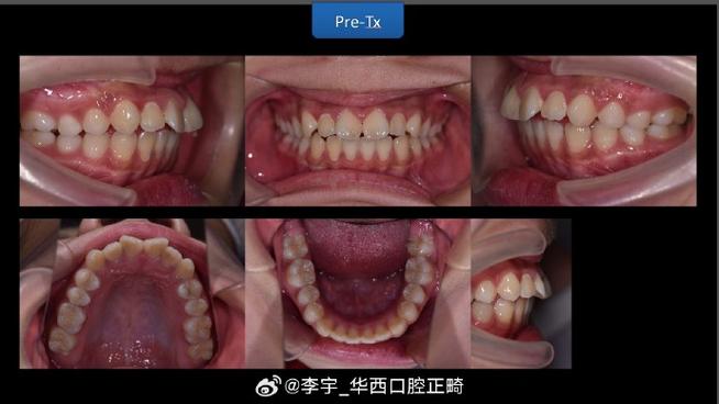 正畸影像技术平行线-图3