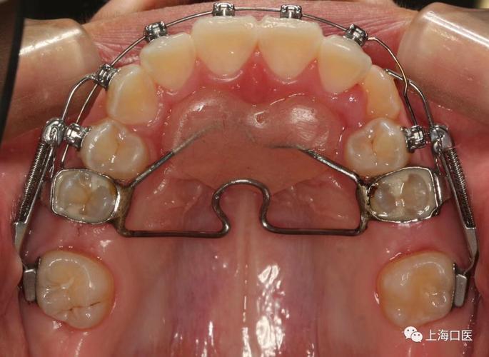 正畸磨牙后推是什么？有何作用与原理？-图2