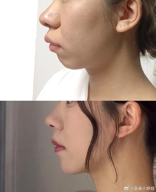 无术前正畸正颌手术-图3