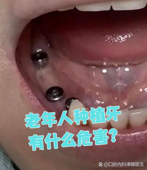 种牙 老年人-图3