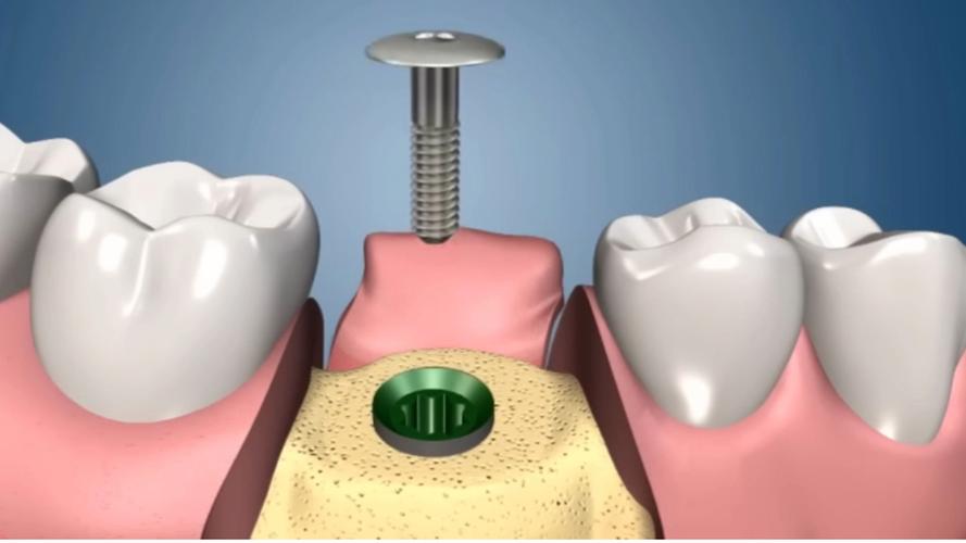 一段式 种牙-图3