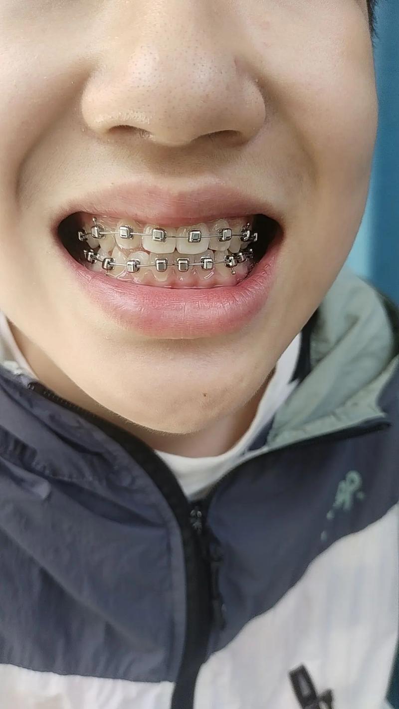 儿童牙齿地包天正畸，何时开始矫正最合适？-图1