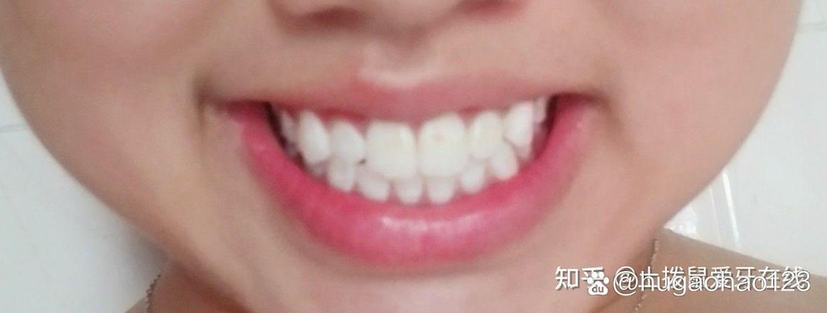 华美正畸效果怎么样-图2