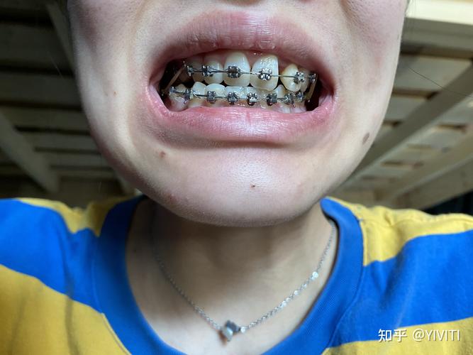 正畸铁丝长牙龈里了-图2
