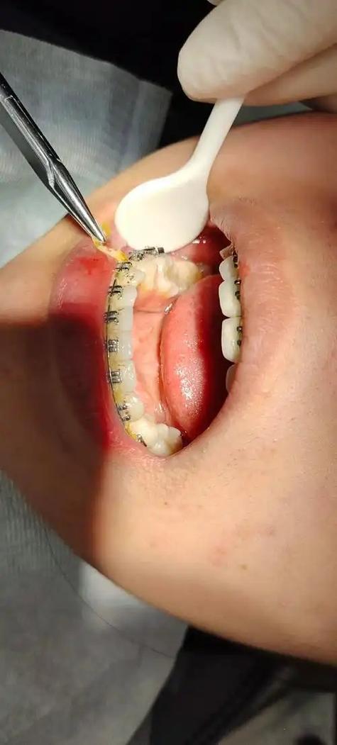 正畸铁丝长牙龈里了-图3