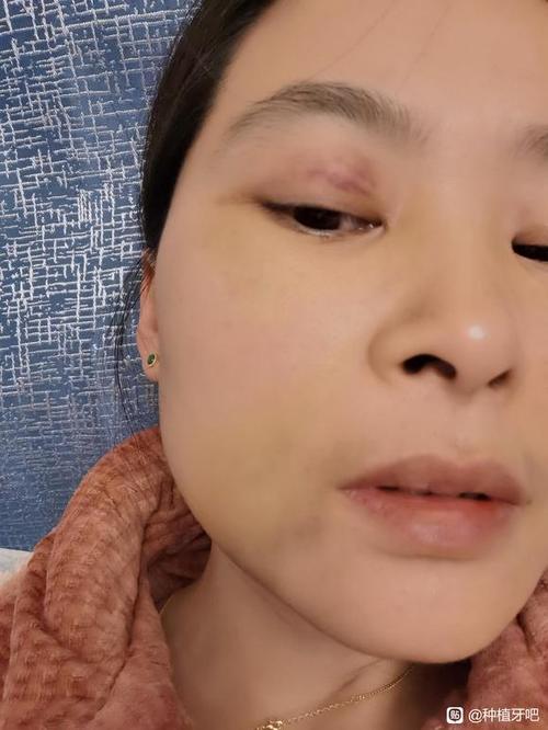 种牙后牙肿了？原因分析与科学应对方法详解-图1