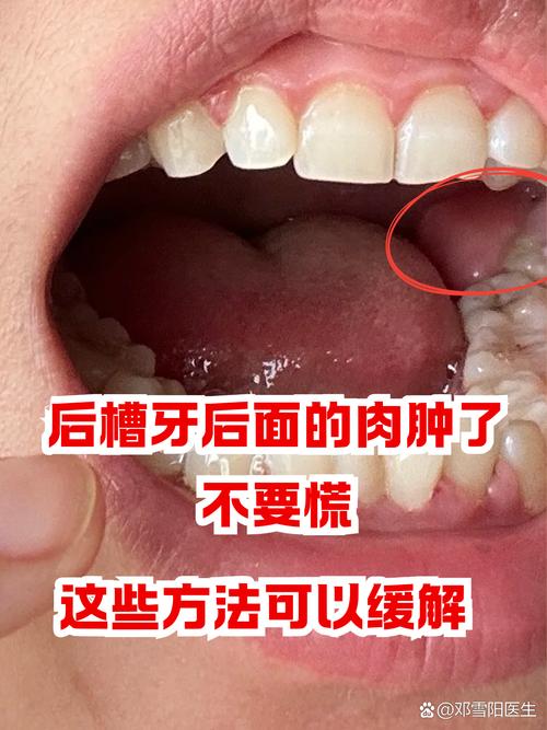 种牙后牙肿了？原因分析与科学应对方法详解-图2