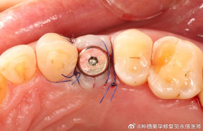 种牙愈合基台-图1