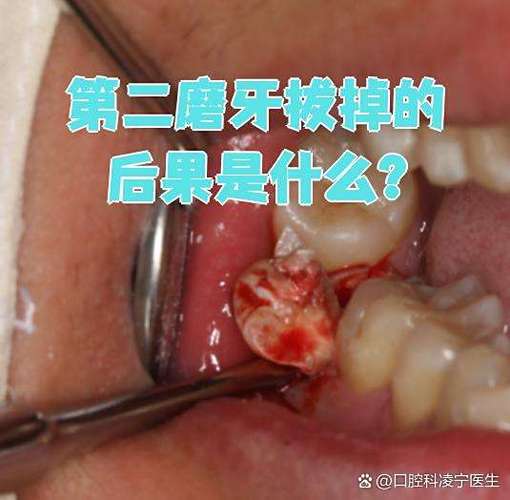 第二前磨牙烂了正畸-图1