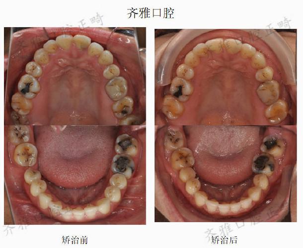 第二前磨牙烂了正畸-图2