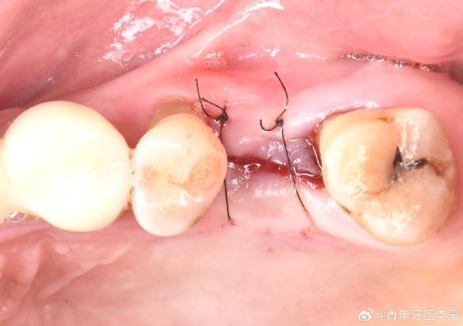 种牙 上颌窦-图2