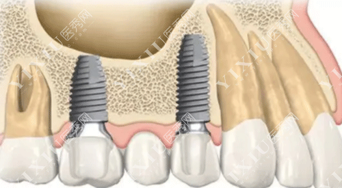 种牙 上颌窦-图1