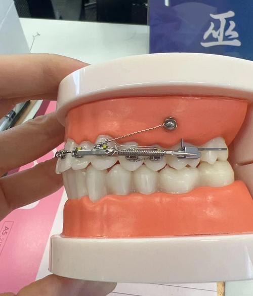 正畸内收多了，能通过拉回矫正吗？-图1