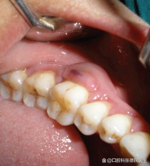 种牙 牙龈肿-图1