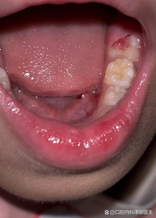 种牙 牙龈肿-图2