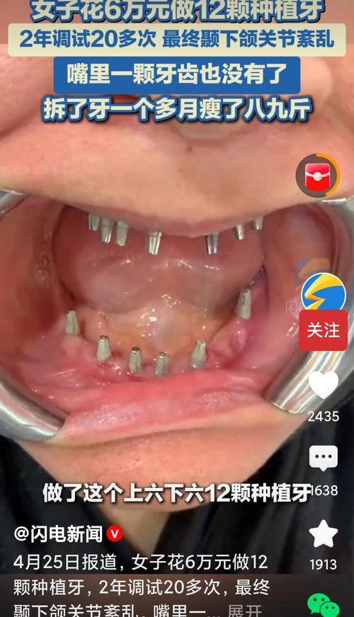 没有牙 种牙-图1