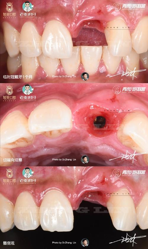 种牙移植牙龈-图3