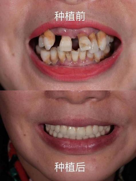 种牙越种越差-图1 种牙越种越差-图1