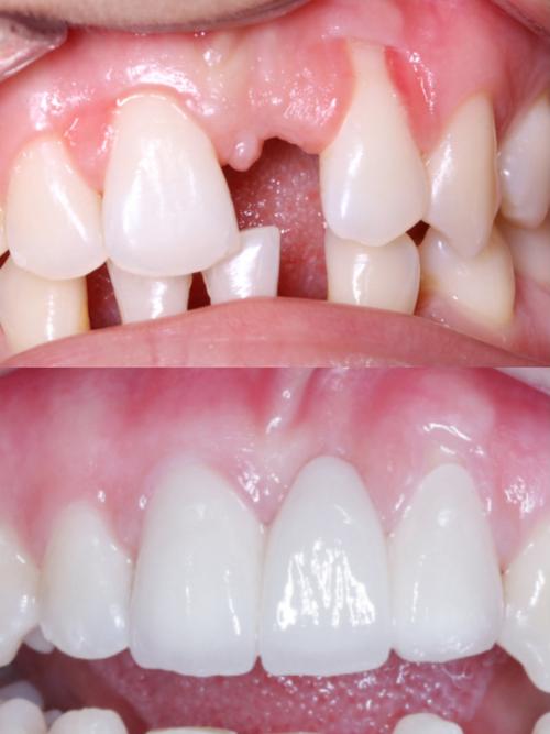 全瓷牙与种牙有何区别？缺牙修复该如何正确选择？-图1